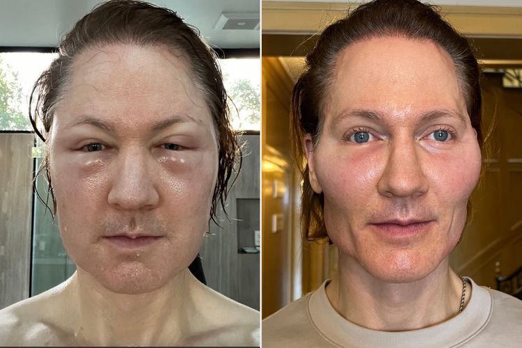 Bryan Johnson suntik lemak di wajah.