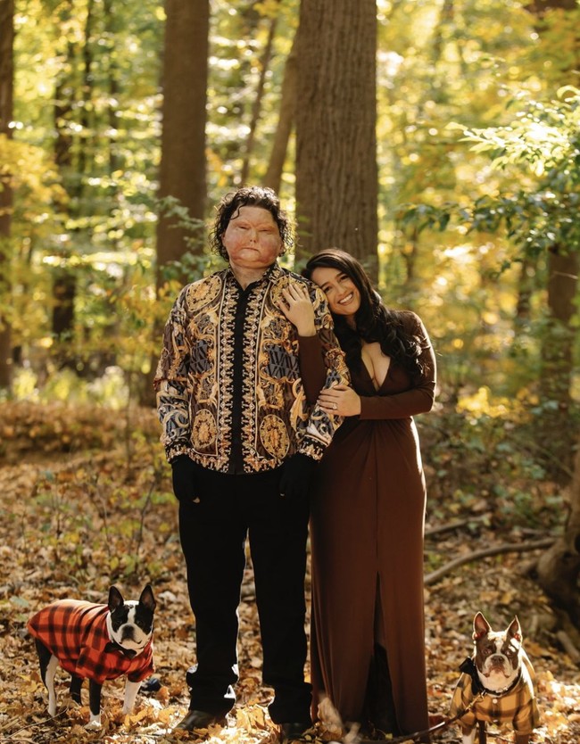 Joe DiMeo, penerima transplantasi wajah dan tangan pertama yang berhasil di dunia menemukan cinta sejatinya di tengah masa terpuruknya. Pria 26 tahun itu baru-baru ini membagikan kabar pertunangannya. Foto: dok. Instagram @jessicakoby