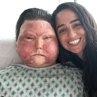 Joe menjalani transplantasi wajah ganda dari pria berusia 48 tahun dan berhasil. Meski kondisi wajahnya tidak seperti semula, namun Joe itu kini wajahnya sudah terbentuk dibanding pascakecelakaan. Foto: dok. Instagram @jessicakoby