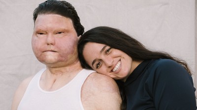 8 Foto Pria Pertama dengan Transplantasi Wajah Bertemu Jodoh, Kini Tunangan