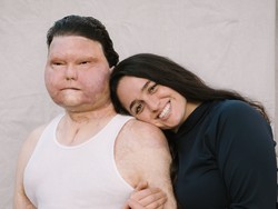 8 Foto Pria Pertama dengan Transplantasi Wajah Bertemu Jodoh, Kini Tunangan