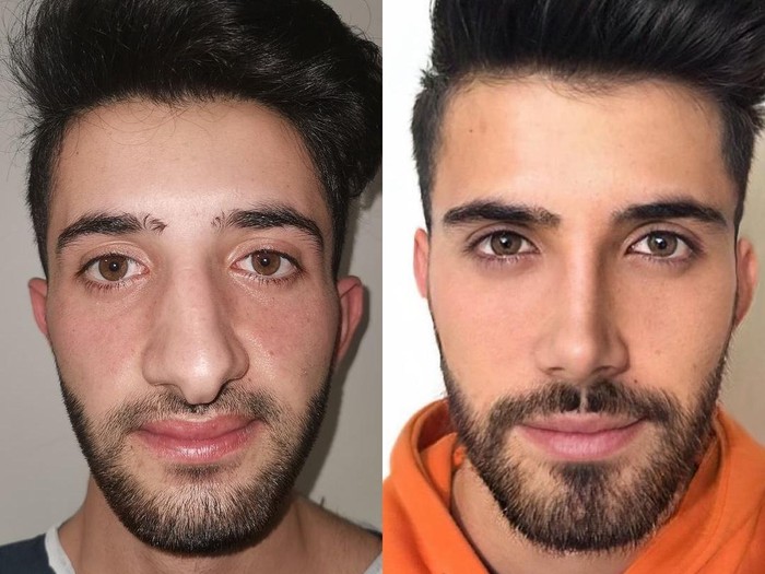 Transformasi pria operasi plastik jadi seperti beda orang.