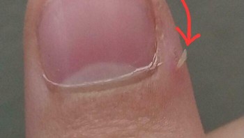 Keselnya saat ditarik biar lepas, eh malah terkelupas lebih panjang lagi. Ingat, pakai gunting kuku ya kalau kalian mengalami hal seperti ini. Foto: (Bored Panda).