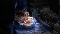 Hasilnya, dibandingkan dengan operasi transplantasi paru-paru pada umumnya, sayatan berkurang dari sekitar delapan inci menjadi dua. NYU Langone Health/Handout via REUTERS