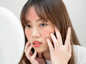 Cara Menghilangkan Jerawat Meradang dengan Cepat, Coba 7 Tips Ini!