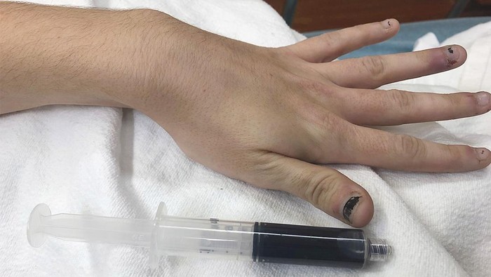 Penampakan Darah Wanita Berubah gegara Efek Obat, Darahnya Literally Biru!