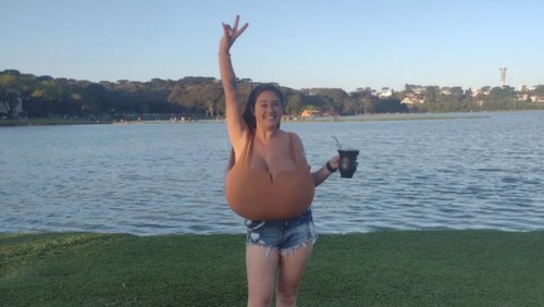 Thaynara Marcondes wanita pengidap gigantomastia.