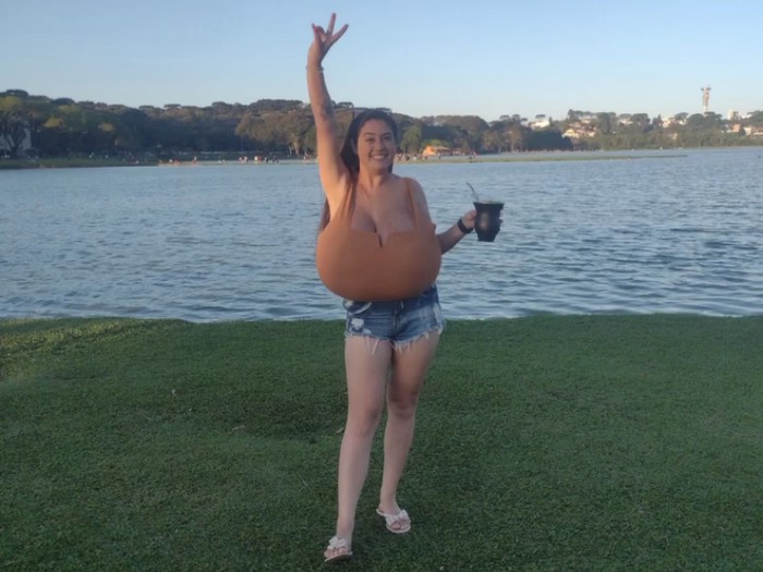 Thaynara Marcondes wanita pengidap gigantomastia.