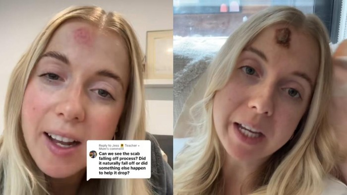 Curhat Wanita Mengira Punya Jerawat Biasa, Tak Tahunya Kanker Kulit di Wajah