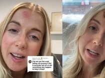 Curhat Wanita Mengira Punya Jerawat Biasa, Tak Tahunya Kanker Kulit di Wajah