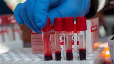 Pemeriksaan Kesehatan untuk Antisipasi HIV