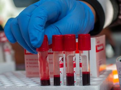 Pemeriksaan Kesehatan untuk Antisipasi HIV
