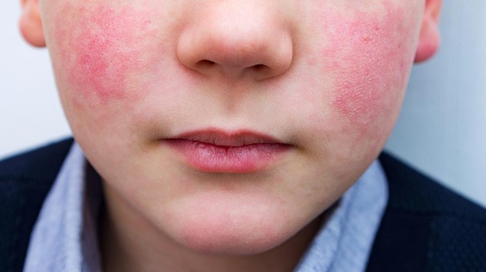 Geger Wabah Sindrom Pipi Tertampar di Jepang, Ibu Hamil-Anak Paling Berisiko