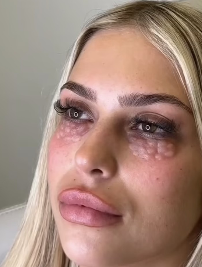 Prosedur kecantikan dengan efek samping kulit reptil