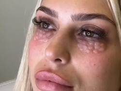 Bahaya Prosedur Kecantikan yang Punya Efek Samping Wajah Seperti Reptil