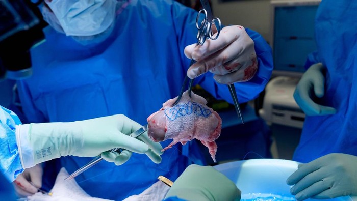 Potret Wanita AS Jalani Operasi Transplantasi Ginjal Babi