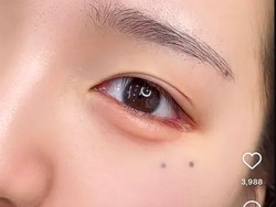 Tato Kantung Mata Jadi Tren di Korea Selatan, Demi Tampil Lebih Muda