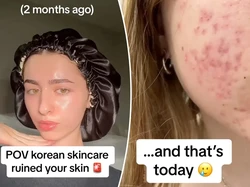 Wajah Jerawatan Gara-gara Tips Skincare Influencer, Dokter Beri Peringatan Ini