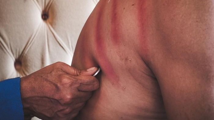 figure of back being scraped with a coin, traditional asian treatment for flatulence by scraping with a coin.