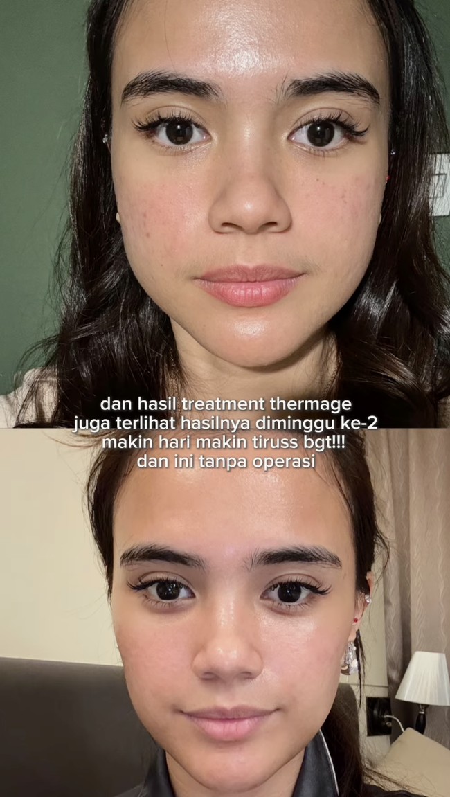 Potret before-after yang ia bagikan memperlihatkan perubahan signifikan. Dari wajah yang sebelumnya dipenuhi bekas jerawat, kini Audi memiliki kulit yang tampak flawless. Transformasi ini membuatnya banjir pujian dari para pengikutnya di media sosial. Foto: dok. Instagram @audimarissa
