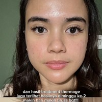  Potret before-after yang ia bagikan memperlihatkan perubahan signifikan. Dari wajah yang sebelumnya dipenuhi bekas jerawat, kini Audi memiliki kulit yang tampak flawless. Transformasi ini membuatnya banjir pujian dari para pengikutnya di media sosial. Foto: dok. Instagram @audimarissa