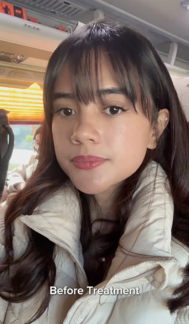 Transformasi wajah Audi pun menarik perhatian banyak netizen, terutama setelah ia membagikan potret before-after yang menunjukkan hasil yang mencengangkan dari perawatan tersebut. Foto: dok. Instagram @audimarissa