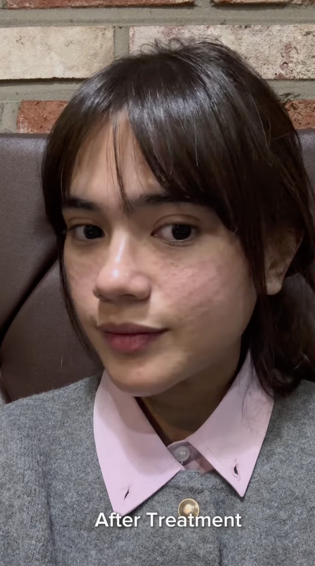 Audi menjalani tujuh perawatan wajah: Thermage, Juvelook Skin, Botox Lifting, Botox Rahang, Shrink Universe, Filler Leher, dan Laser Hair Removal. Foto: dok. Instagram @audimarissa