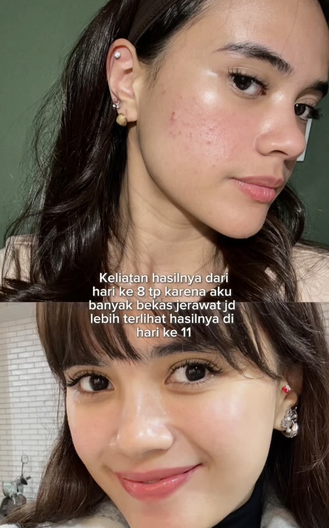 Wanita 29 tahun itu mengungkapkan bahwa ia menjalani perawatan di Tune Clinic, sebuah klinik kecantikan ternama di Korea Selatan. Dalam unggahan di Instagram, Audi menceritakan pengalamannya. Menurut Audi, perubahan mulai terlihat sejak hari kedelapan, meskipun hasil maksimal baru tampak jelas setelah dua minggu perawatan. Foto: dok. Instagram @audimarissa