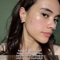 Wanita 29 tahun itu mengungkapkan bahwa ia menjalani perawatan di Tune Clinic, sebuah klinik kecantikan ternama di Korea Selatan. Dalam unggahan di Instagram, Audi menceritakan pengalamannya. Menurut Audi, perubahan mulai terlihat sejak hari kedelapan, meskipun hasil maksimal baru tampak jelas setelah dua minggu perawatan. Foto: dok. Instagram @audimarissa