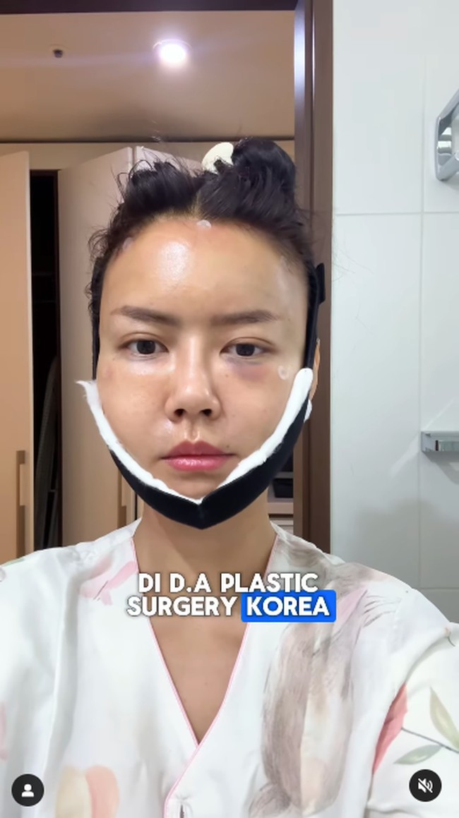 Selagi lemak tubuhnya diambil, kemudian ia memutuskan sekalian melakukan liposuction di area lengan, paha dan double chin. “Biar sekalian dibuang lemak-lemak yg mengendap di bagian tersebut,” tulisnya di Instagram.6Foto: Instagram Nita Gunawan