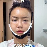 Selagi lemak tubuhnya diambil, kemudian ia memutuskan sekalian melakukan liposuction di area lengan, paha dan double chin. “Biar sekalian dibuang lemak-lemak yg mengendap di bagian tersebut,” tulisnya di Instagram.6Foto: Instagram Nita Gunawan