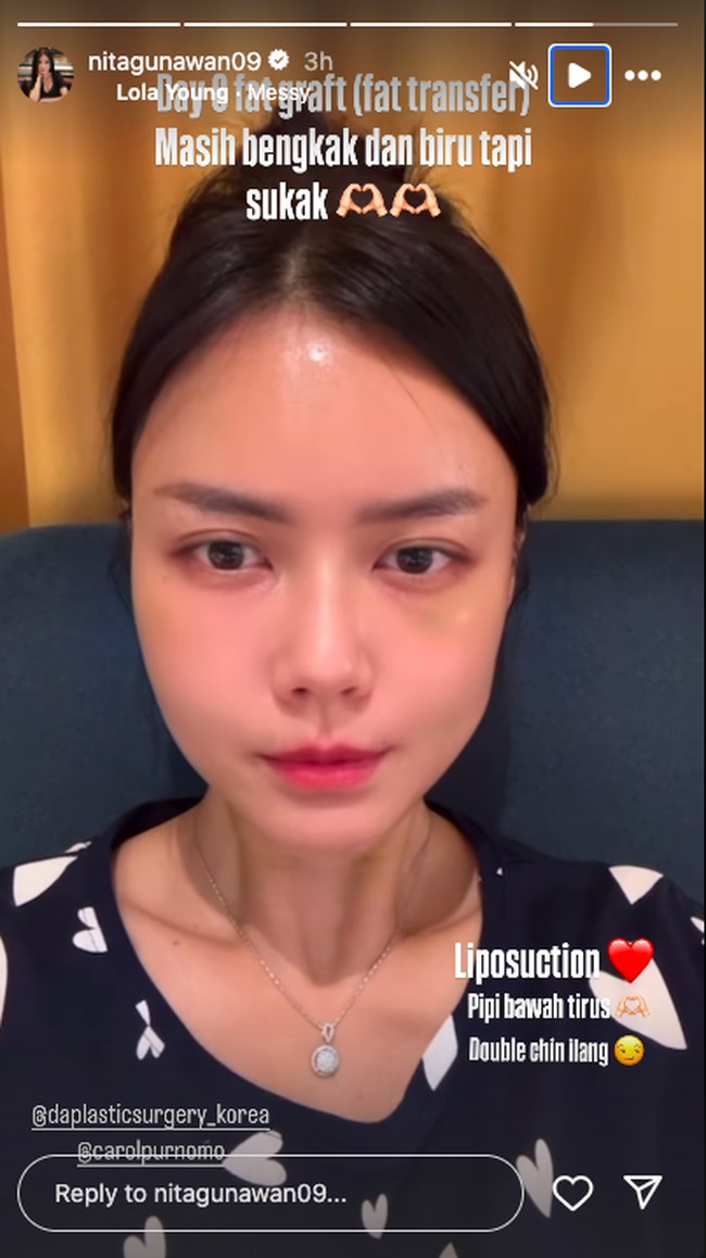 Begini penampilan terbarunya setelah melakukan liposuction dan fat graft tersebut. Foto: Instagram Nita Gunawan