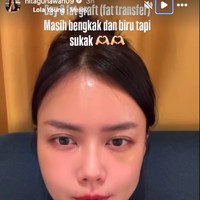 Begini penampilan terbarunya setelah melakukan liposuction dan fat graft tersebut. Foto: Instagram Nita Gunawan