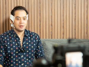 Kriss Hatta Lakukan Transplantasi Rambut Untuk Jaga Penampilan
