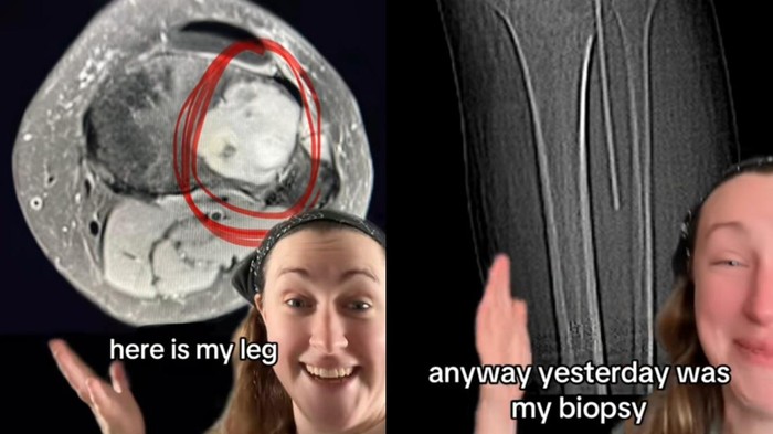 Dikira Cuma Terkilir, Wanita Ini Ternyata Punya Tumor di Kakinya