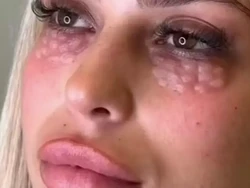 Viral Tren Kecantikan Atasi Mata Panda, Bikin Berakhir Jadi Bak Kulit Reptil