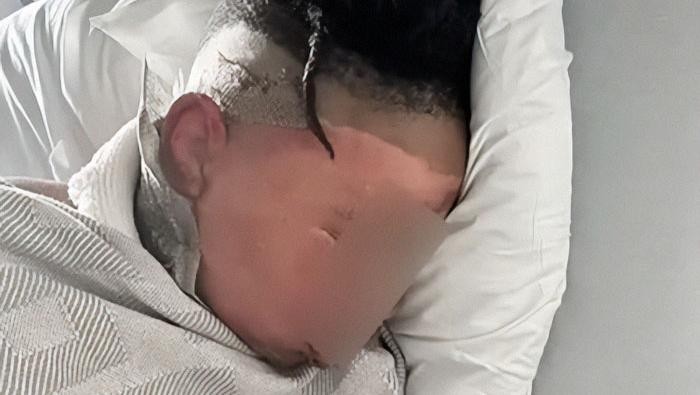 Bercanda boleh, tapi tetap ada batasannya. Sebuah kasus prank mengakibatkan luka bakar tingkat dua pada wajah korbannya menjadi pelajaran nyata.