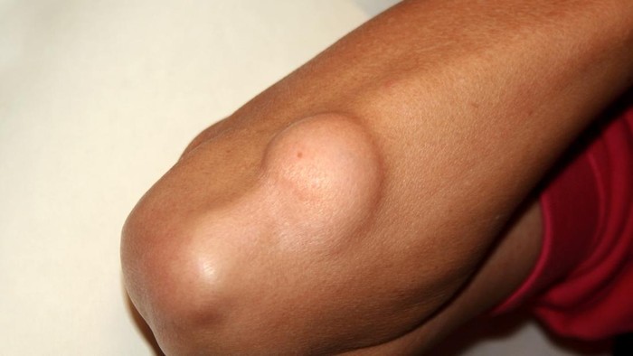 Apa Itu Uci-uci? Ini Penyebab, Ciri-ciri, dan Pengobatannya