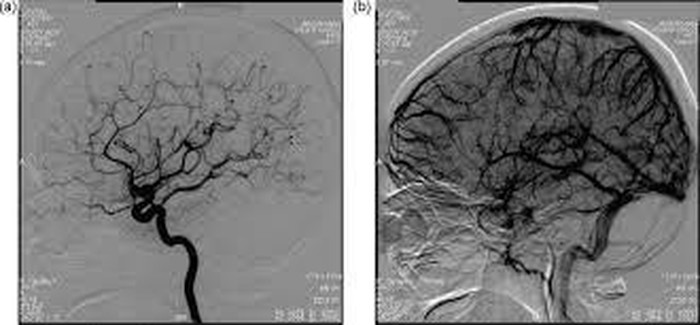 DSA Cerebral Mayapada Hospital: Solusi untuk Sakit Kepala Berkepanjangan