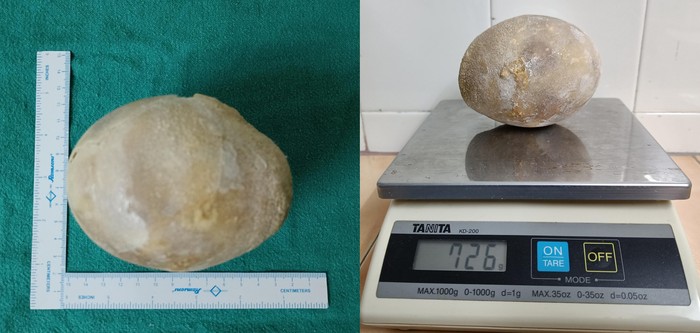 batu kandung kemih raksasa