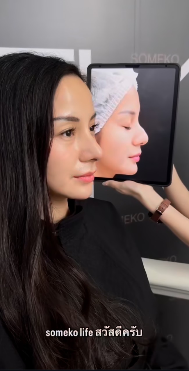 Kirana mengaku tak memiliki sinus, tujuannya menjalani operasi plastik tersebut murni untuk tujuan estetika. Wanita 37 tahun itu pun membagikan foto before vs after dirinya menjalani rhinoplasty. Terlihat jelas hidung Kirana yang semula bengkok kini sudah lurus. Foto: Instagram/@kiranalarasati