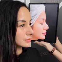 Kirana mengaku tak memiliki sinus, tujuannya menjalani operasi plastik tersebut murni untuk tujuan estetika. Wanita 37 tahun itu pun membagikan foto before vs after dirinya menjalani rhinoplasty. Terlihat jelas hidung Kirana yang semula bengkok kini sudah lurus. Foto: Instagram/@kiranalarasati