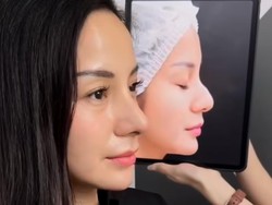 7 Foto Kirana Larasati Usai Rhinoplasty di Bangkok, Hidung Tak Lagi Bengkok
