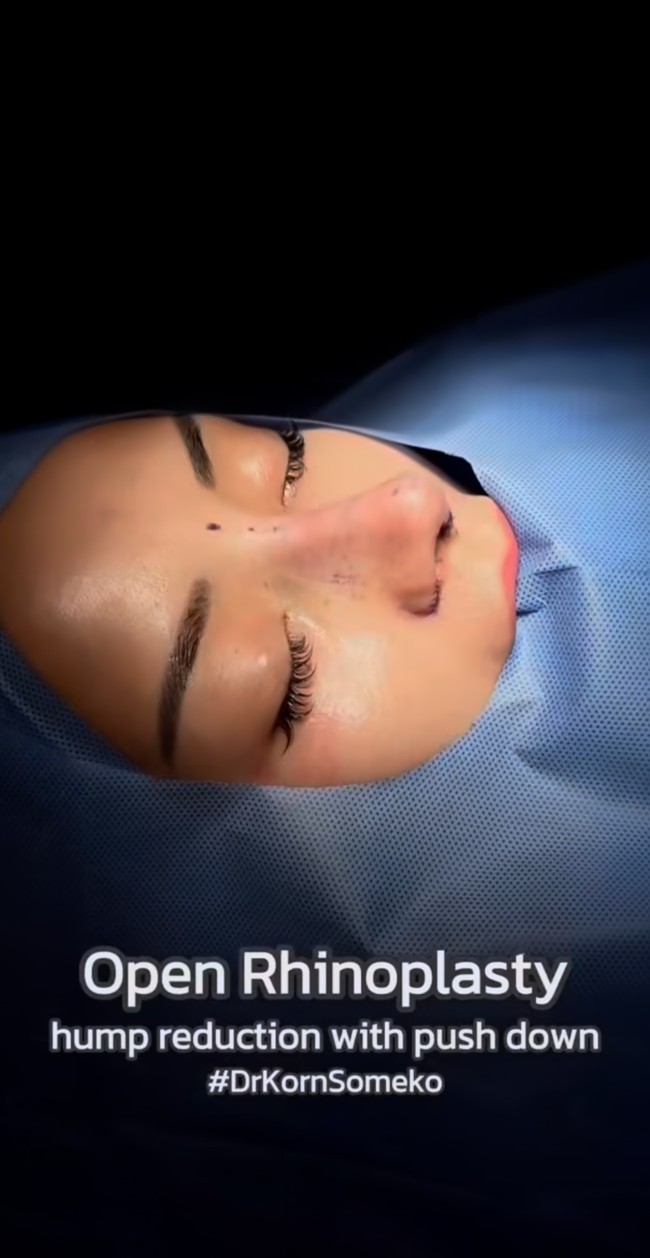 Melalui akun Instagram pribadinya Kirana Larasati membagikan momen saat dirinya menjalani rhinoplasty di Bangkok pada Desember 2024. Kirana mengaku menjalani operasi tersebut untuk membetulkan tulang hidungnya yang bengkok. Foto: Instagram/@kiranalarasati