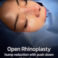 Melalui akun Instagram pribadinya Kirana Larasati membagikan momen saat dirinya menjalani rhinoplasty di Bangkok pada Desember 2024. Kirana mengaku menjalani operasi tersebut untuk membetulkan tulang hidungnya yang bengkok. Foto: Instagram/@kiranalarasati