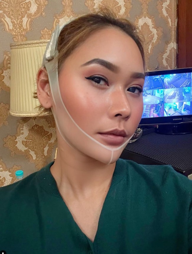 Dalam unggahannya Inul juga mengungkap rahasia pipi tirusnya, yaitu dengan mengenakan korset pada bagian rahang dan samping pipinya. Tak hanya itu saja, Inul juga menjalani prosedur tarik benang agar kulit wajahnya tetap kencang. Foto: Instagram/@inul.d