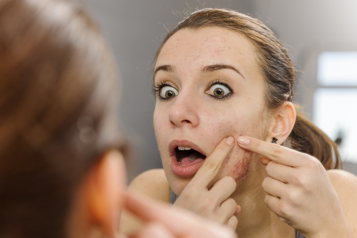 Perbedaan Bisul dan Jerawat