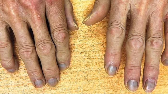 Kulit Kakek Ini Mendadak Berubah Jadi Abu-abu, Ternyata Ini Alasan Medisnya