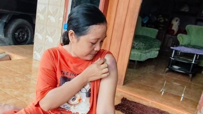 Ibu rumah tangga jadi korban begal di Situbondo menunjukkan luka memarnya