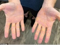 Hanya Makan Daging Sapi dan Keju, Tubuh Pria Ini Penuh Warna Kuning